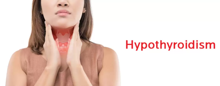 Hypothyrodism Disease.