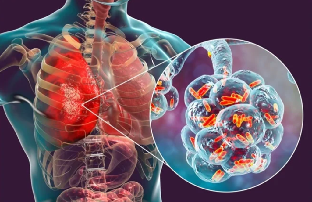 Pneumonia Disease