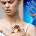 Arthritis in women