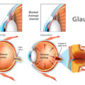 glaucoma Disease