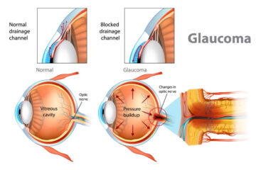 glaucoma Disease