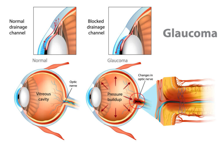 glaucoma Disease