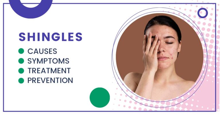 Shingles treatment