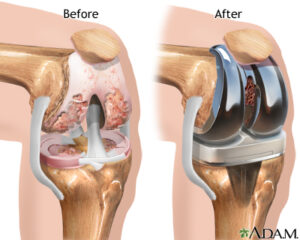 Knee replacement